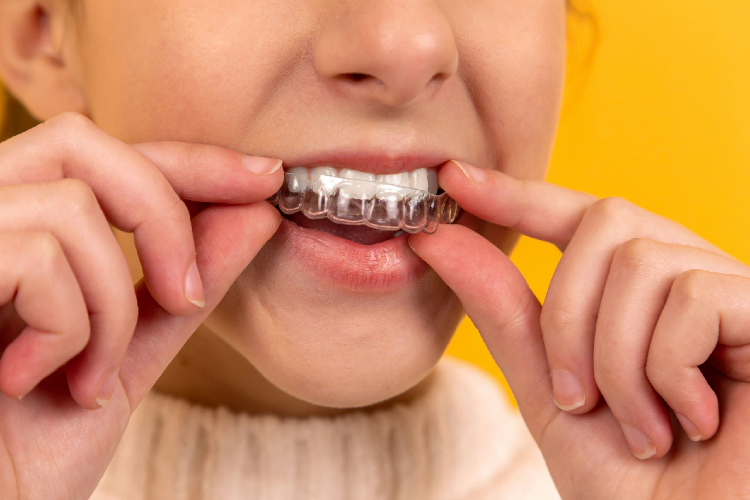 How Invisalign Can Improve Your Oral Health Beyond Straightening Teeth