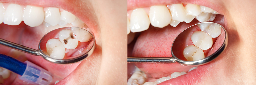 Understanding Dental Fillings: Types, Benefits, and Procedure